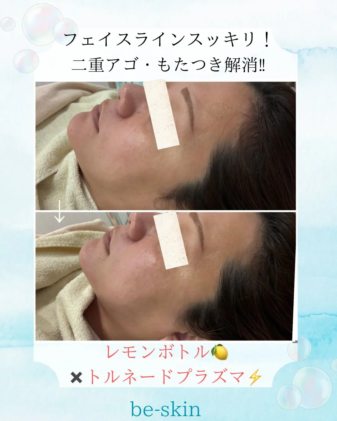 レモンボトル🍋✖️トルネードプラズマ⚡️