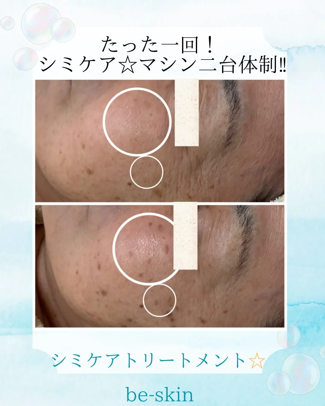 シミケア+韓国肌管理